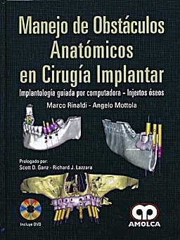 Manejo de Obstáculos Anatómicos en Cirugía Implantar. Implantología Guiada por Computadora - Rinaldi
