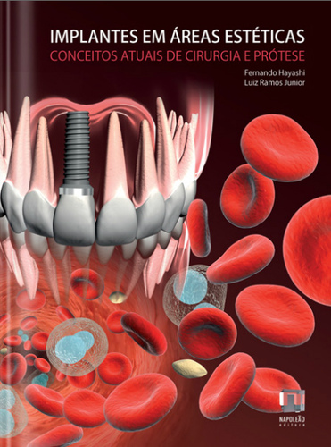 Implantes en áreas estéticas: Conceptos actuales en cirugía e implantes - F. Hayashi E Luiz Ramos Junior