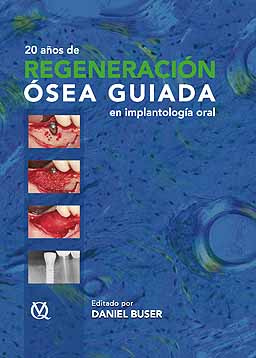 20 Años de Regeneración Ósea Guiada en Implantología - Daniel Buser