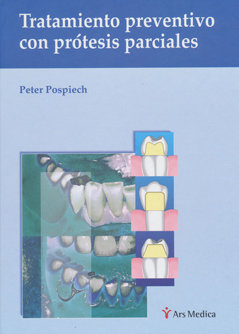 Tratamiento preventivo con prótesis parciales - P.Pospiech
