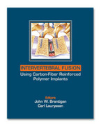 Intervertebral Fusion Using Carbon Fiber Reinforced Polymer Implants - Brantigan / Lauryssen
