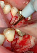 Piezosurgery: State of the Art in Implantology - Vercellotti