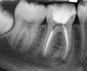 Endo or Implant: Rational decision making from an Endodontist's viewpoint - Buchanan