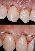 Esthetic Periodontology (Crown Lengthening & Root Coverage) - Saadoun