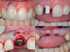 Achieving Ultimate Aesthetics with Implants in the Aesthetic Zone (3 Lecture Series) - Mankoo