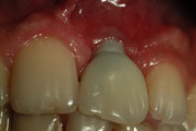 Esthetic Implant Failures - Etiologies and Solutions - Butler