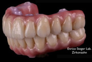 Complete Zirconia Restorations - Implant Supported - Rojas-Vizcaya