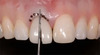 Provisional Restoration - The Overlooked Link to Aesthetic and Functional Perfection - Paul