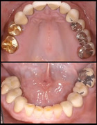 Restorative Excellence - Occlusion on Implant Retained Restorations - Paul