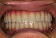 Newest Dental Laboratory Techniques in Implant Esthetics - Casellini