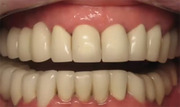 A New Common Sense Approach to Full Mouth Rehabilitation Using Direct Composite and Limited Implants - Ruiz