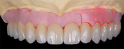 Immediate Tooth Replacement: Review, Articles, and Cases - Mintrone