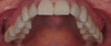 No Post No Crown - Biomimetic Restorative Dentistry - Pascal Magne