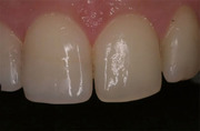 Comparison and Contrast of Direct vs. Indirect Anterior Restorations in Natural Teeth - Papazoglou