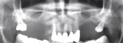 Edentulous Jaw and Different Implant Treatment Options - Jovanovic