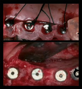Advanced Implant Treatment Planning - A Systematic Approach - Aalam / Reshad