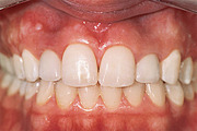 Shade Selection to Match Natural Teeth and Adjacent Restorations - Paul