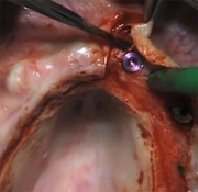 Soft Tissue Management During Maxillary Implant Recovering - Euwe