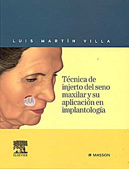 TECNICA DE INJERTO DEL SENO MAXILAR Y SU APLICACION EN IMPLANTOLOGIA - Martin Villa