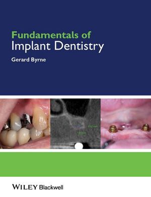 Fundamentals of Implant Dentistry - Byrne