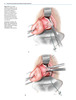Tratamiento Quirúrgico de Prolapso de órganos pélvicos - Karram / F. Maher