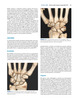 Artritis y Artroplastia Mano, Muñeca y Codo - Bobby Chhabra