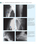 Guía Visual de Tumores Musculoesqueléticos - Wodajo / Murphey / Gannon
