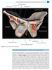 Cirugía para la Incontinencia Urinaria - Dmochowski / Karram / Reynolds