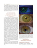 Guia quirúrgica completa para la corrección del astigmatismo - Henderson / Gills