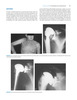 Artritis y Artroplastia del Hombro - David M. Dines