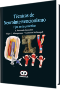 TECNICAS DE NEUROINTERVENCIONISMO TIPS EN LA PRACTICA - Gonzalez / Albuquerque / McDougall