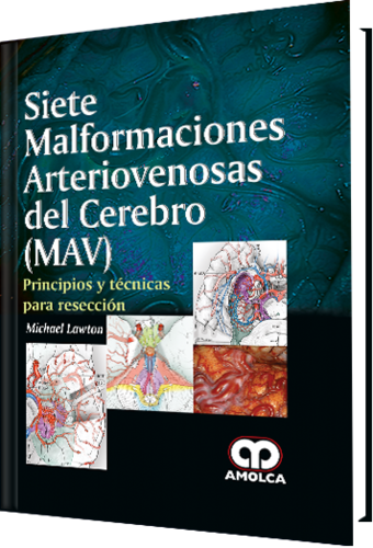 SIETE MALFORMACIONES ARTERIOVENOSAS DEL CEREBRO (MAV) - Lawton
