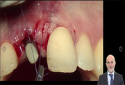 Soft tissue management and esthetic failure around osteointegrated implants - Zucchelli