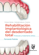REHABILITACIÓN IMPLANTOLÓGICA DEL DESDENTADO TOTAL: Protocolo y tratamiento clínico - Pedrola