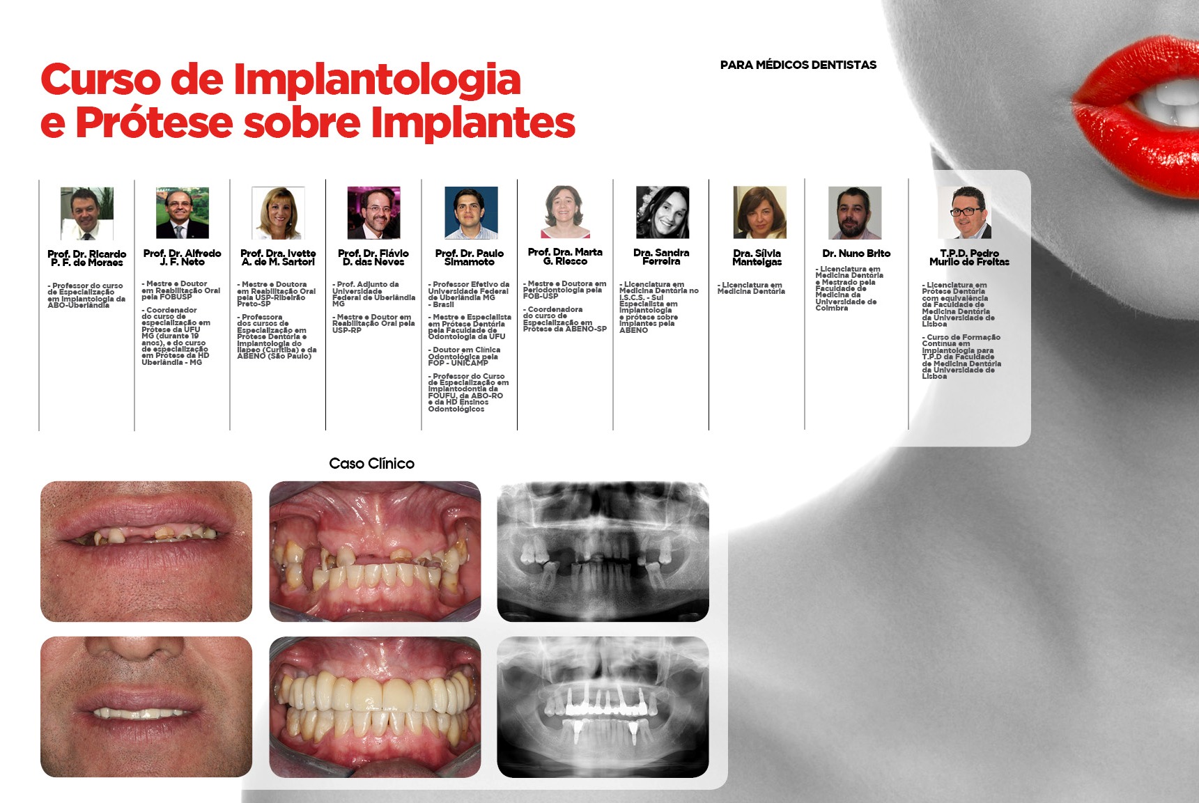9º Curso de Implantologia e Prótese sobre Implantes - Maxillaris
